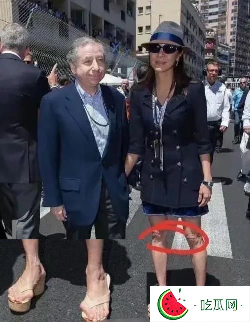 楊紫瓊腳趾頭外翻近照圖片，是什么原因造成的？
